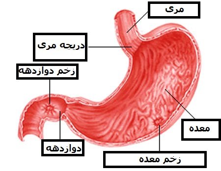 زخم معده چیست؟ راه درمان آن کدام است؟