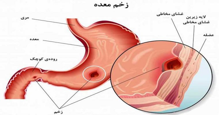 زخم معده چیست؟ راه درمان آن کدام است؟